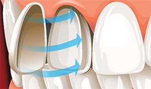 Реставрации зубов керамическими винирвами      